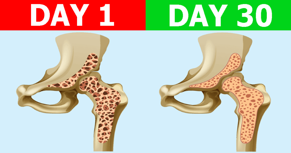 OsteoShield Day-1-30